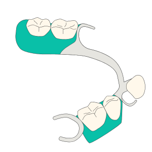 PRÓTESIS REMOVIBLES